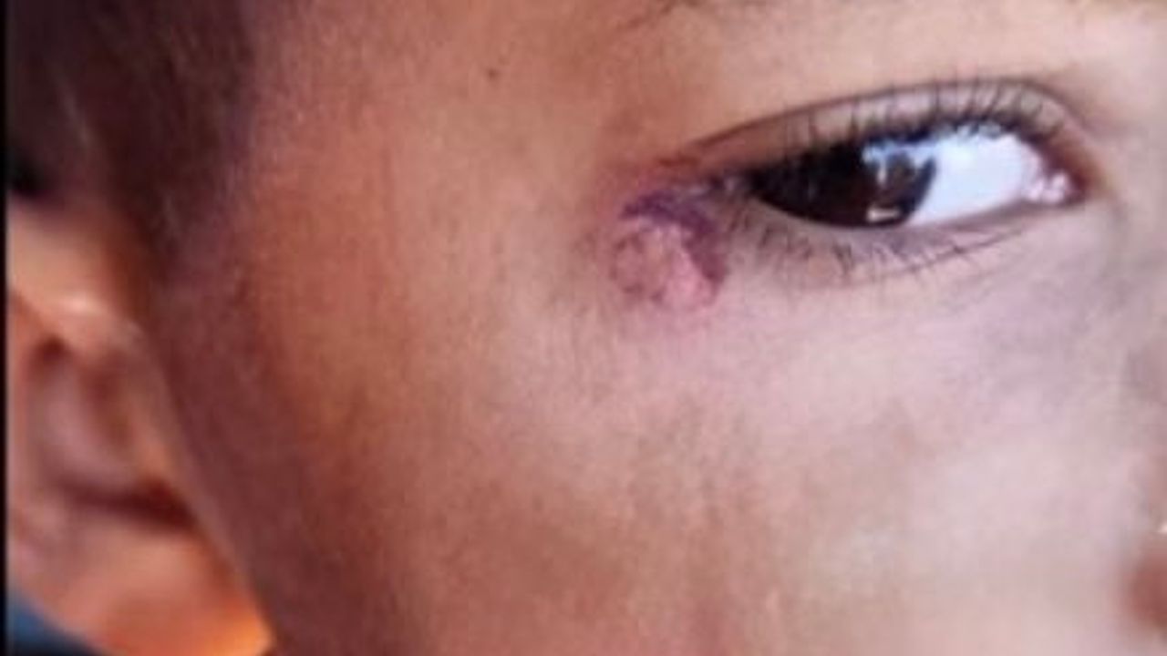 Öğrencinin Yüzünde Sigara Söndürdü: Temizlikçi Tutuklandı