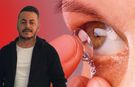 Kontakt lens kullanımında hayati uyarı: Lensler asla suyla temas etmemeli