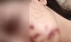 Siirt’te Maytap Faciası: Genç Kız Yüzünden Yaralandı