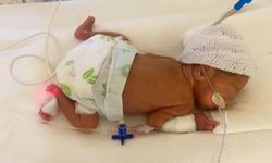 780 Gram Doğan Elfin Bebek, 6 Ay Sonra Sağlığına Kavuştu
