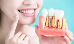 Gülüş Tasarımı Sadece Estetik Değil: Fonksiyonel ve Kişiye Özel