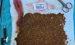 Hastadan Çıkan Taşları Sayamadılar