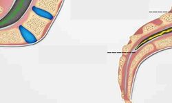 Gergin Omurilik Sendromu Nedir, Belirtileri Nelerdir? Uzmandan Uyarı