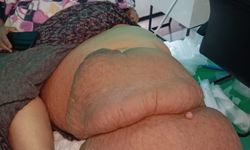 Fil Hastalığı Bacağını 100 Kilo Yaptı, Tedavisinin Devamı İçin Destek Bekliyor