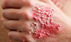 Zona Hastalığı Geçirenler Dikkat! Yıllar Sonra Hayat Kalitesini Düşürüyor