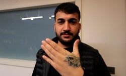 Dövme Sildirme Sırasında Eli Yandı "Ağrın varsa ağrı kesici al" Denildi