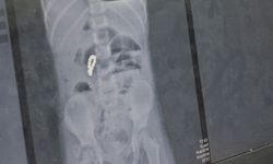 Kusma Şikayetiyle Gitti Bağırsağından 8 Adet Mıknatıslı Boncuk Çıktı