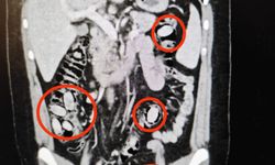 Midesinden 44 kapsül uyuşturucu madde bonzai çıktı