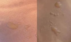 Karnına Koyduğu Sıcak Su Torbası Patladı: Vücudunda Yanıklar Oluştu