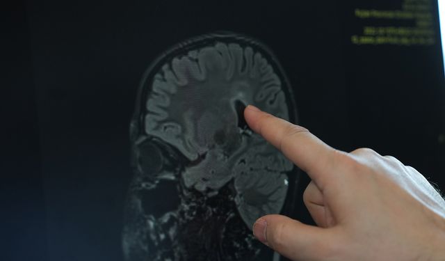 Serebral Palsiye Cerrahi Müdahale ile Yeni Bir Umut