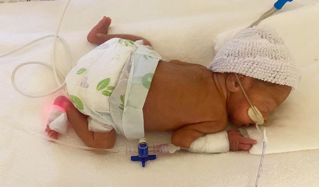 780 Gram Doğan Elfin Bebek, 6 Ay Sonra Sağlığına Kavuştu