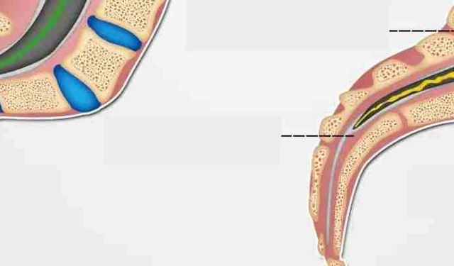 Gergin Omurilik Sendromu Nedir, Belirtileri Nelerdir? Uzmandan Uyarı