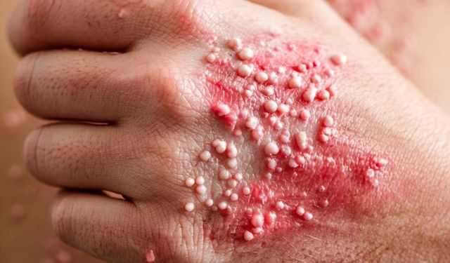 Zona Hastalığı Geçirenler Dikkat! Yıllar Sonra Hayat Kalitesini Düşürüyor