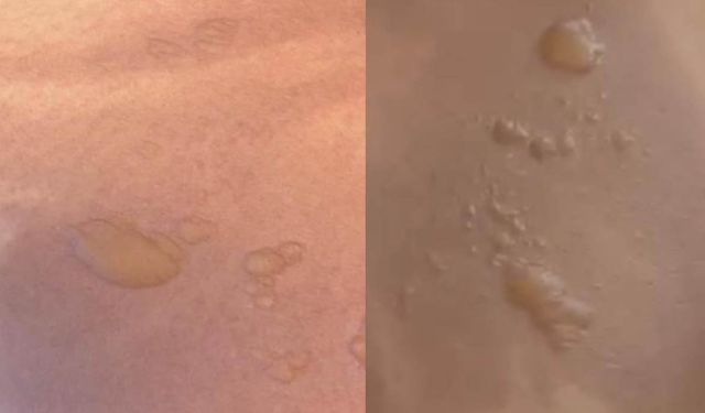 Karnına Koyduğu Sıcak Su Torbası Patladı: Vücudunda Yanıklar Oluştu