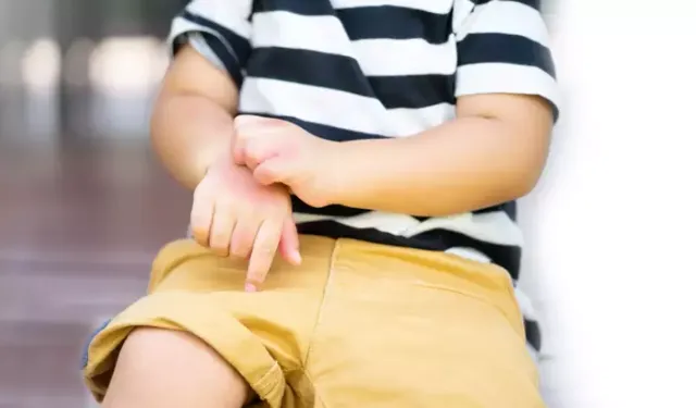 Uzmanından Uyarı: Egzama Çocuk ve Erişkinlerde Yaşam Kalitesini Düşürüyor