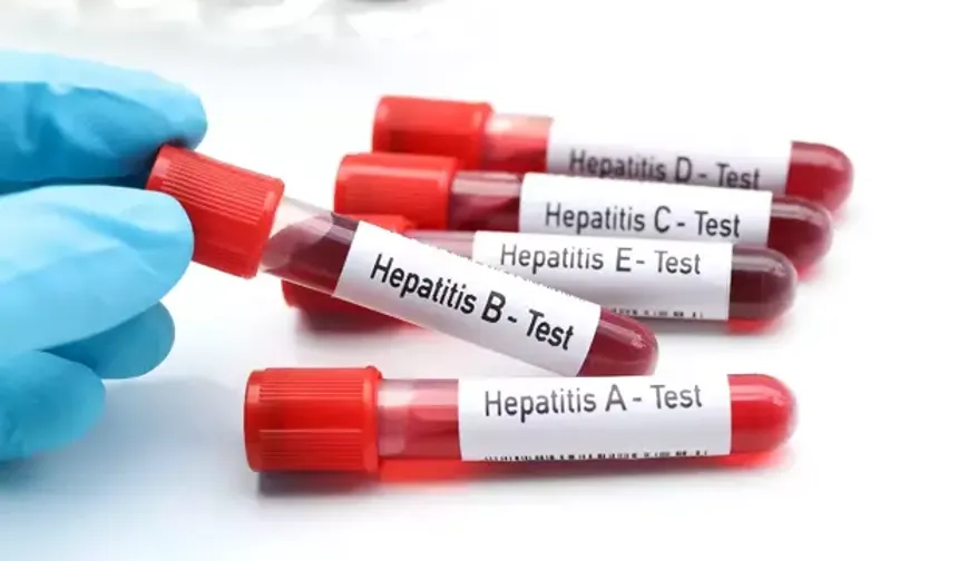 Hepatit B ve C'nin Tehlikesi: 1,5 Milyon Ölüme Sebep Oluyor