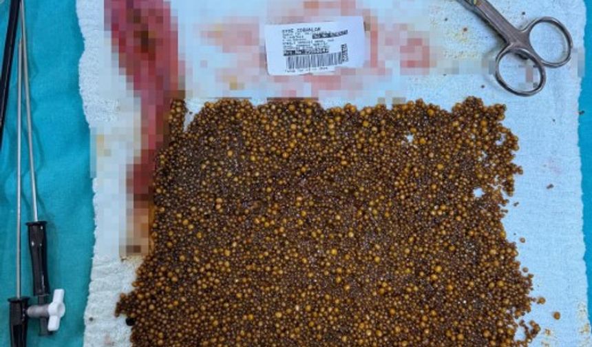 Hastadan Çıkan Taşları Sayamadılar