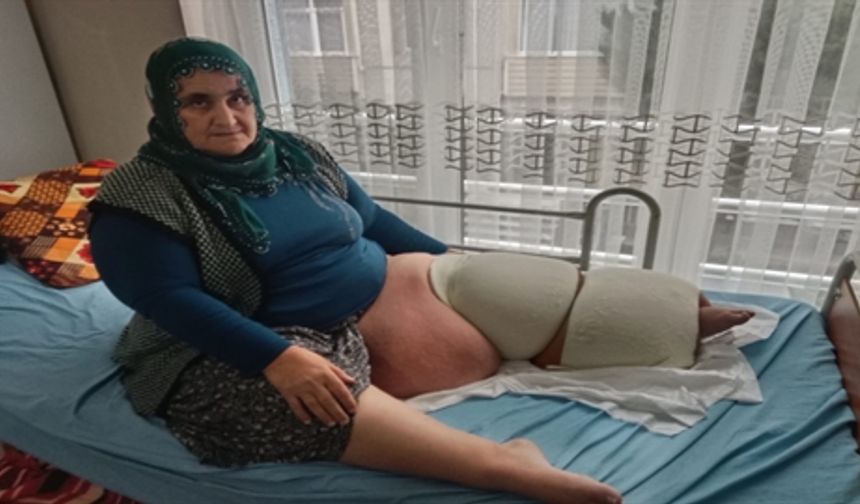 35 Yıldır Fil Hastalığıyla Yaşıyor: Tedavi İçin Arazilerini Satmak Zorunda Kaldılar