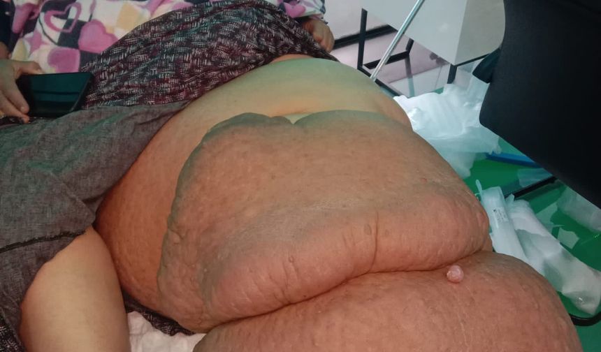 Fil Hastalığı Bacağını 100 Kilo Yaptı, Tedavisinin Devamı İçin Destek Bekliyor