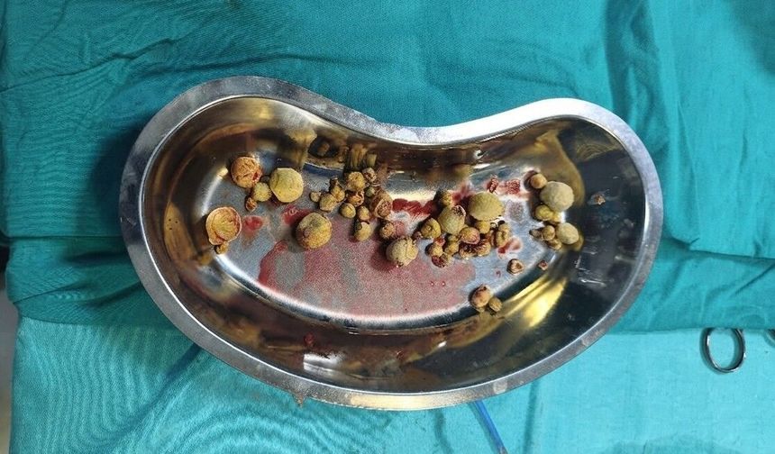 Mesanesinden 42 parça taş çıkarıldı