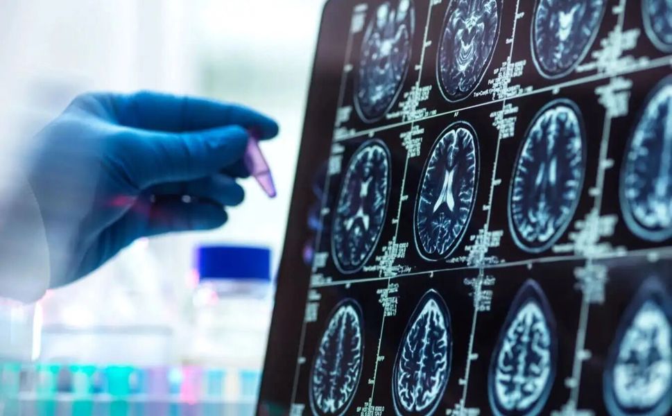 Alzheimer düşünüldüğünden daha erken başlayabilir