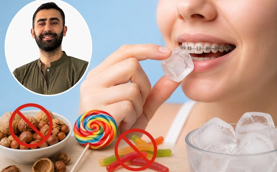 Yaz aylarında diş teli kullananlara beslenme uyarısı